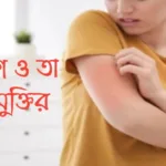 চর্মরোগ থেকে মুক্তির উপায় চর্মরোগ-থেকে-মুক্তির-উপায়